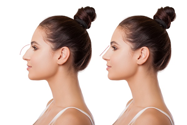 Common Nose Surgery Procedures